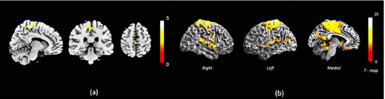 psychosisbrainscan-1.jpg